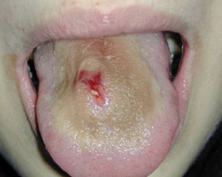 Серьезная инфекция после пирсинга языка