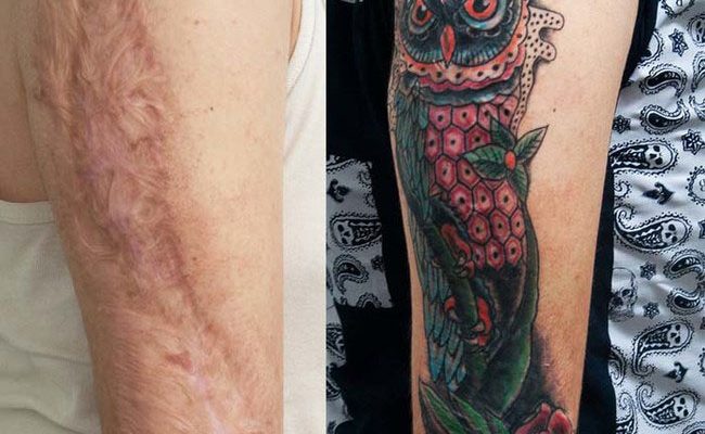 Можно ли делать тату на шрамах? Какие татуировки можно перекрыть? Отвечаем на вопросы