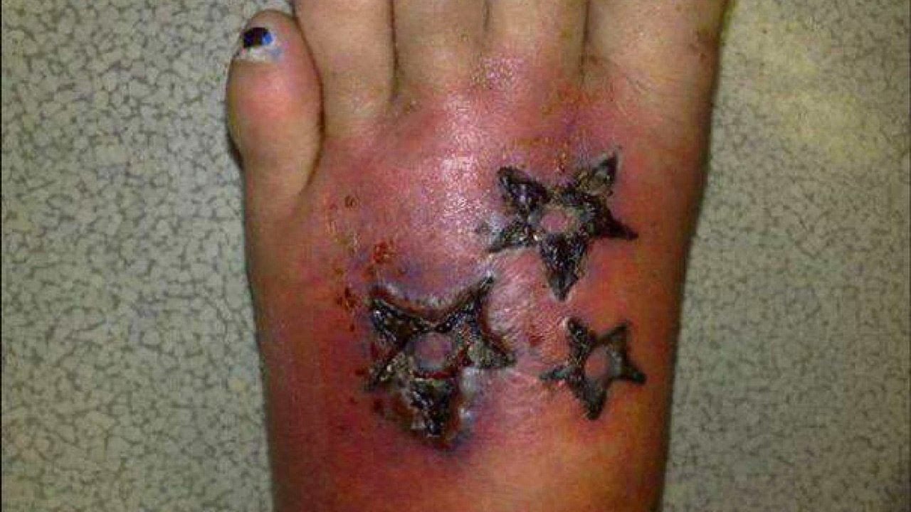Воспаления после татуировки